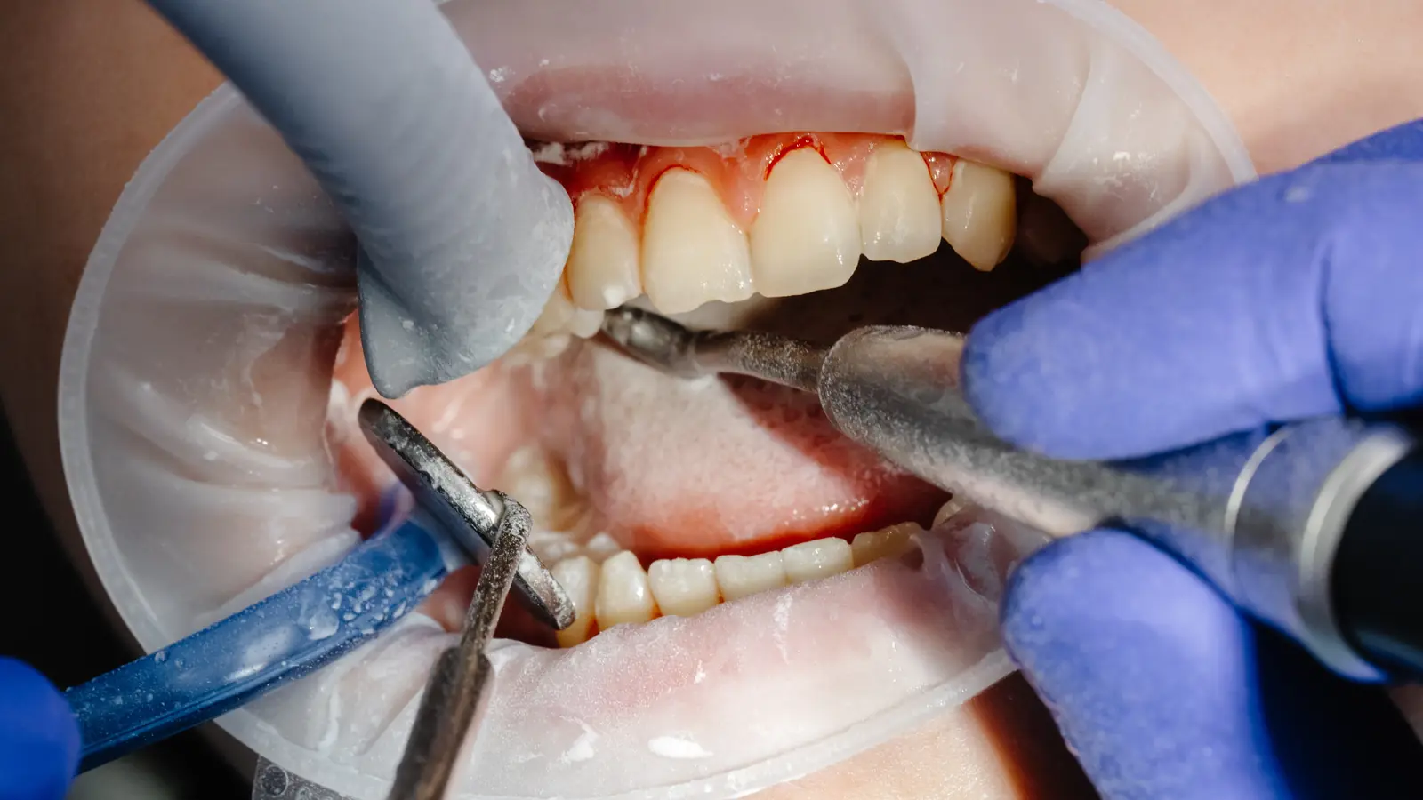 Dental procedure being carried out in a patient's mouth with instruments and suction