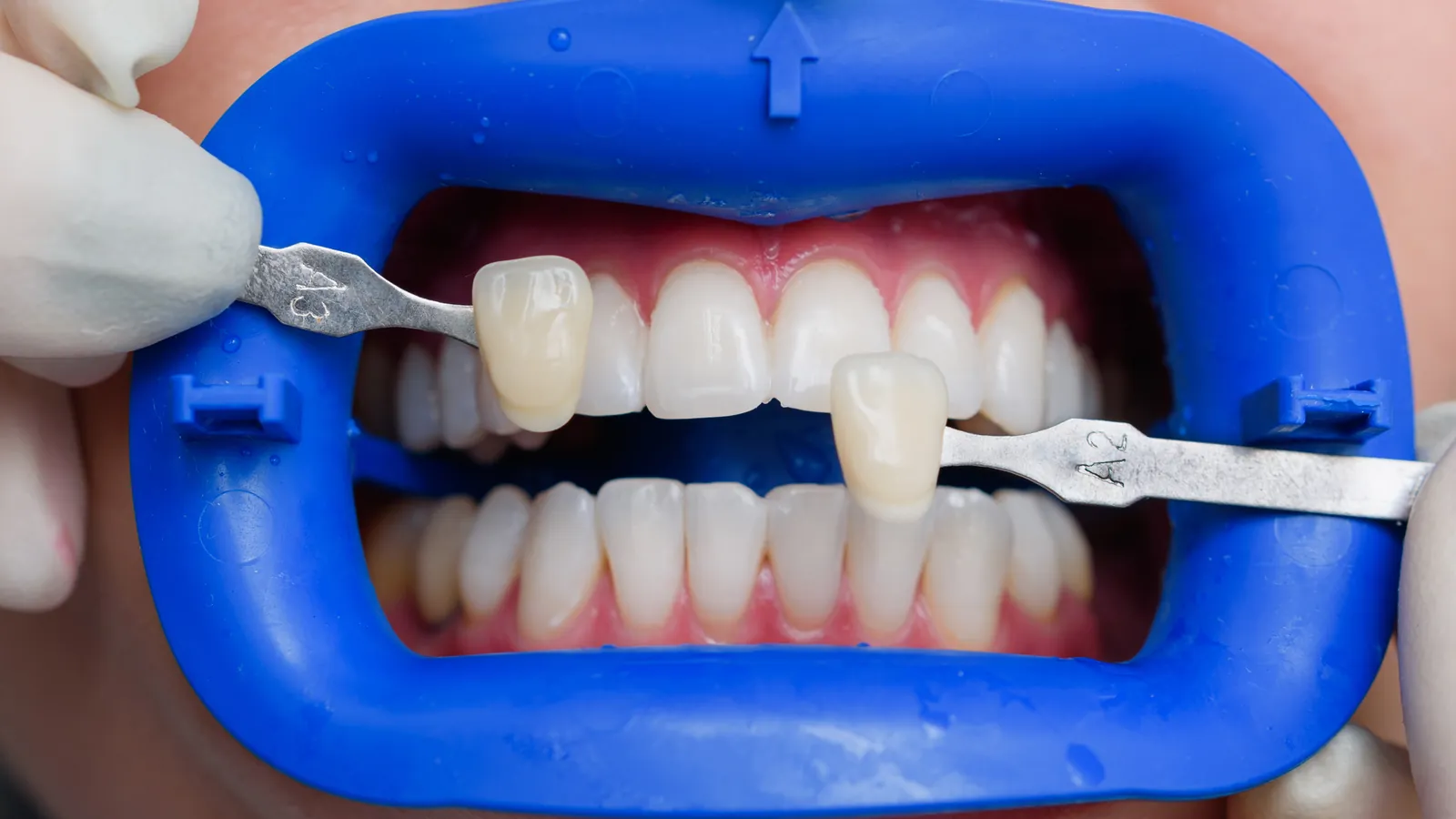 Dentist comparing tooth shade guide tabs against a patient's teeth during shade matching